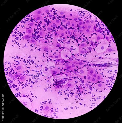 pap cellular changes atrophy.